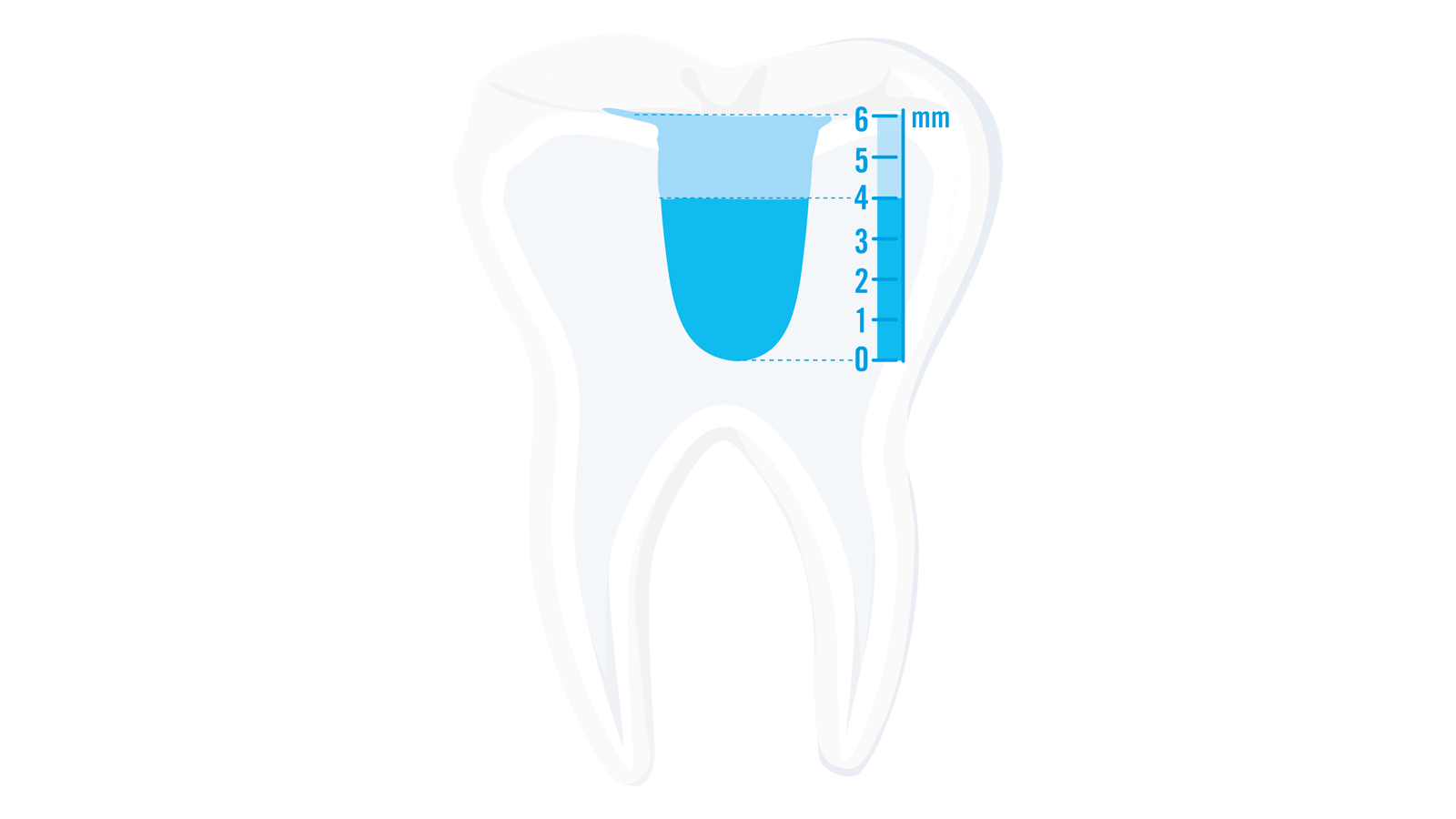 Venus Bulk Flow ONE is ideal for deeper cavities of up to 4mm.