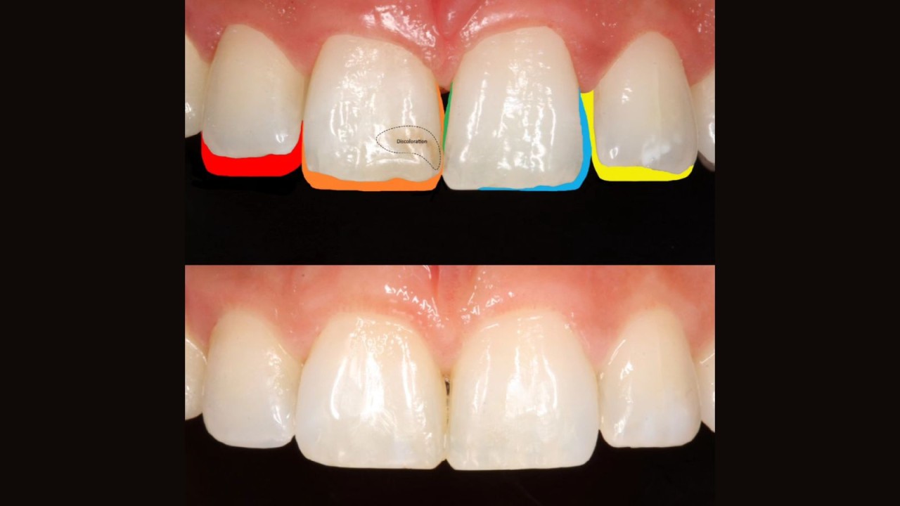 Final monochromatic aesthetic reconstruction of the incisors