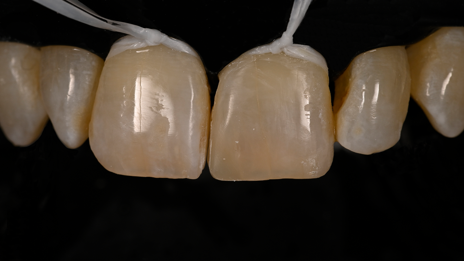 Restoration of tooth 21