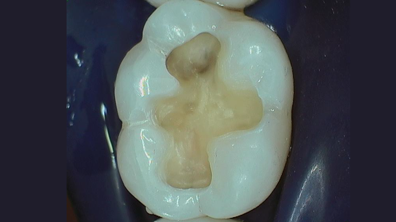Old restoration removed and tooth prepared for new restoration