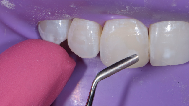 Smoothening of the labial layer