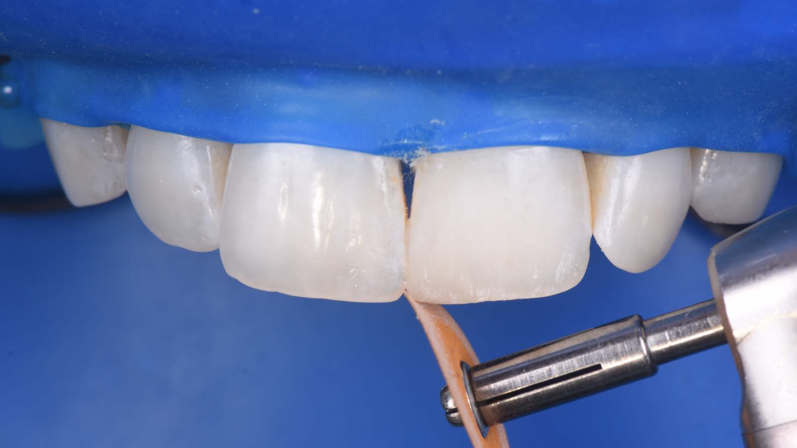 Starting the polishing sequence with pop-on discs to correct the form and surface texture. 